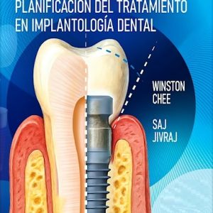 Planificación del Tratamiento en Implantología Dental